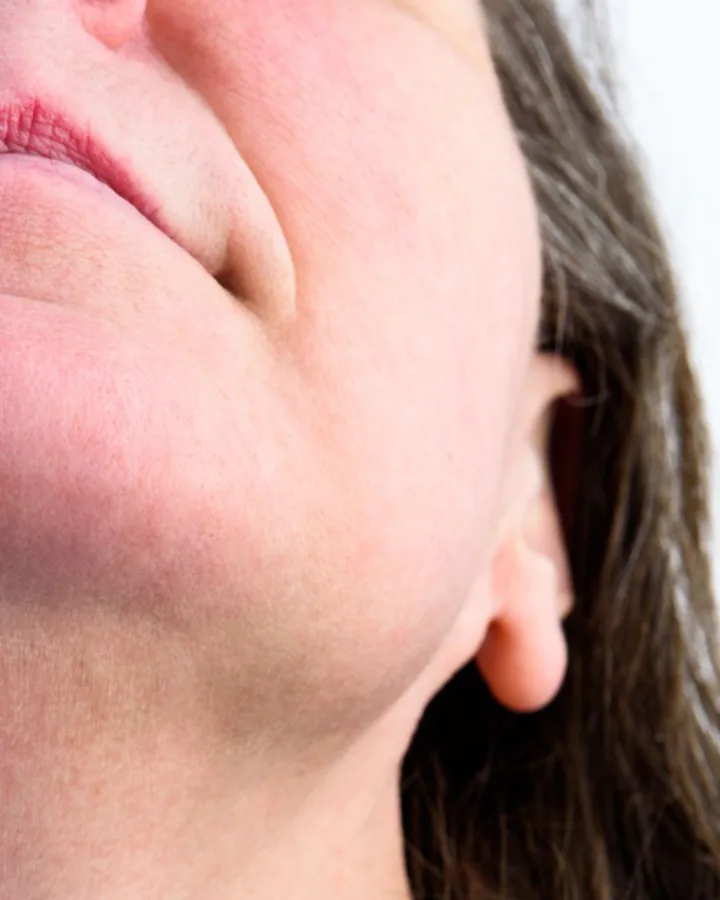 Yüz ve Sakal — after OMEGA laser hair removal