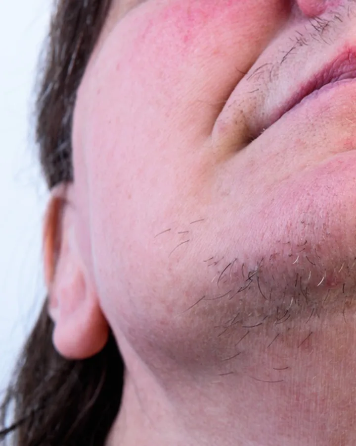 Yüz ve Sakal — before treatment